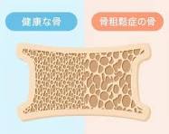 「骨粗しょう症予防」